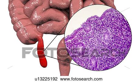 Acute suppurative appendicitis, computer illustration and light micrograph. Illustration of a human appendix that is red and inflamed in appendicitis. The appendix is a narrow finger-shaped tube that branches off the first part of the large intestine... View Large Photo Image Stock Image - Acute suppurative appendicitis, computer illustration and light micrograph. Illustration of a human appendix that is red and inflamed in appendicitis. The appendix is a narrow finger-shaped tube that branches off the first part of the large intestine.... Fotosearch