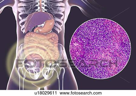 Acute suppurative appendicitis, computer illustration and light micrograph. Illustration of a human appendix that is red and inflamed in appendicitis. The appendix is a narrow finger-shaped tube that branches off the first part of the large intestine... View Large Photo Image Stock Image - Acute suppurative appendicitis, computer illustration and light micrograph. Illustration of a human appendix that is red and inflamed in appendicitis. The appendix is a narrow finger-shaped tube that branches off the first part of the large intestine.... Fotosearch