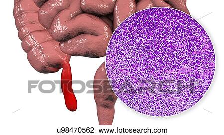 Acute suppurative appendicitis, computer illustration and light micrograph. Illustration of a human appendix that is red and inflamed in appendicitis. The appendix is a narrow finger-shaped tube that branches off the first part of the large intestine... View Large Photo Image Stock Image - Acute suppurative appendicitis, computer illustration and light micrograph. Illustration of a human appendix that is red and inflamed in appendicitis. The appendix is a narrow finger-shaped tube that branches off the first part of the large intestine.... Fotosearch