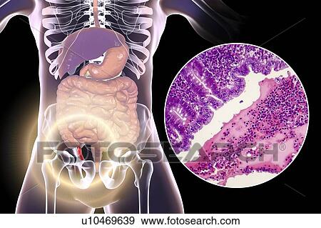 Stock Photo - Acute suppurative appendicitis, computer illustration and light micrograph. Illustration of a human appendix that is red and inflamed in appendicitis. The appendix is a narrow finger-shaped tube that branches off the first part of the large intestine.... Fotosearch