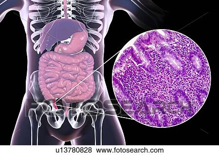 Acute suppurative appendicitis, computer illustration and light micrograph. Illustration of a human appendix that is red and inflamed in appendicitis. The appendix is a narrow finger-shaped tube that branches off the first part of the large intestine... View Large Photo Image Stock Photo - Acute suppurative appendicitis, computer illustration and light micrograph. Illustration of a human appendix that is red and inflamed in appendicitis. The appendix is a narrow finger-shaped tube that branches off the first part of the large intestine.... Fotosearch