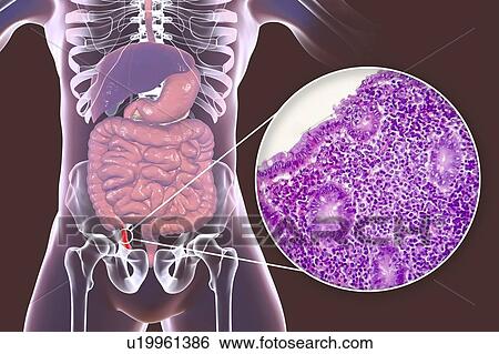 Acute suppurative appendicitis, computer illustration and light micrograph. Illustration of a human appendix that is red and inflamed in appendicitis. The appendix is a narrow finger-shaped tube that branches off the first part of the large intestine... View Large Photo Image Stock Photograph - Acute suppurative appendicitis, computer illustration and light micrograph. Illustration of a human appendix that is red and inflamed in appendicitis. The appendix is a narrow finger-shaped tube that branches off the first part of the large intestine.... Fotosearch