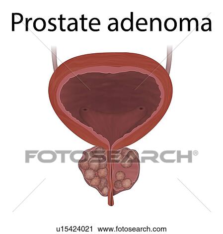 Stock Image - Adenoma of the prostate gland, illustration.. Fotosearch