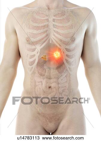 Adrenal gland tumour, conceptual computer illustration. View Large Photo Image Stock Image - Adrenal gland tumour, conceptual computer illustration.. Fotosearch
