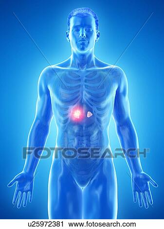 Stock Image - Adrenal gland tumour, conceptual computer illustration.. Fotosearch
