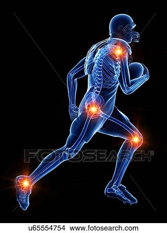 Picture - American football player with painful joints, illustration. Fotosearch