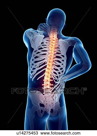 Stock Image - Back pain, computer illustration.. Fotosearch