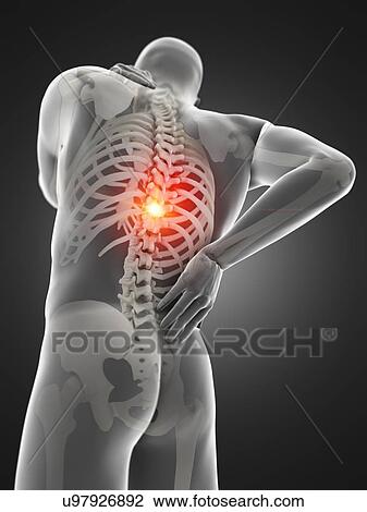 Back pain, computer illustration. View Large Photo Image Stock Image - Back pain, computer illustration.. Fotosearch
