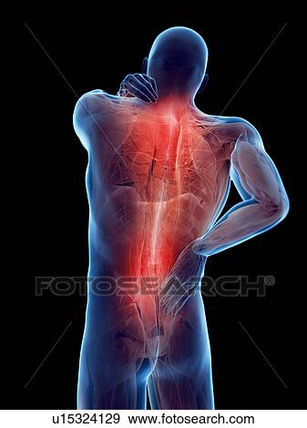 Stock Photo - Back pain, computer illustration.. Fotosearch