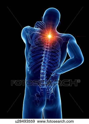 Back pain, computer illustration. View Large Photo Image Stock Photo - Back pain, computer illustration.. Fotosearch