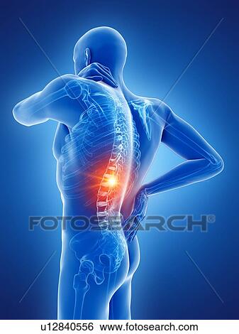 Back pain, computer illustration. View Large Photo Image Stock Photograph - Back pain, computer illustration.. Fotosearch
