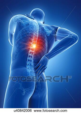 Stock Photograph - Back pain, computer illustration.. Fotosearch