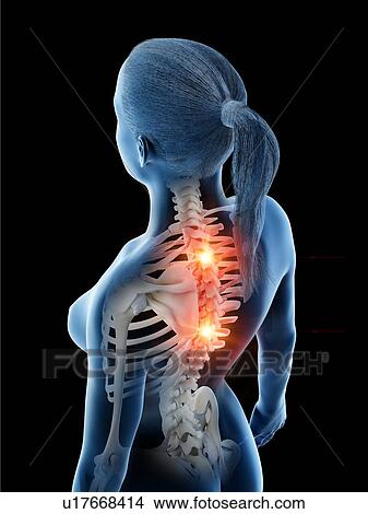Picture - Back pain, conceptual computer illustration.. Fotosearch