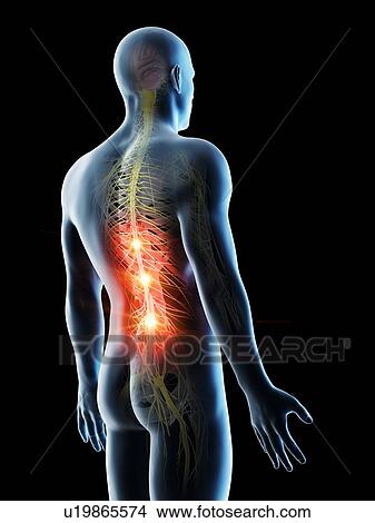 Back pain, conceptual computer illustration. View Large Photo Image Picture - Back pain, conceptual computer illustration.. Fotosearch
