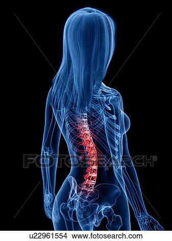 Picture - Back pain, conceptual illustration. Fotosearch