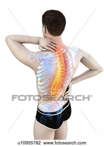 Stock Image - Back pain, conceptual illustration.. Fotosearch