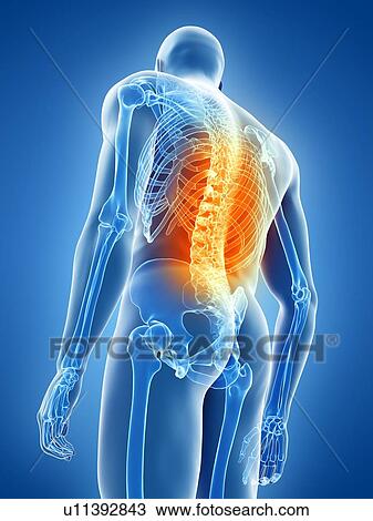 Stock Image - Back pain, conceptual illustration. Fotosearch