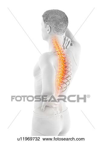 Stock Image - Back pain, conceptual illustration.. Fotosearch