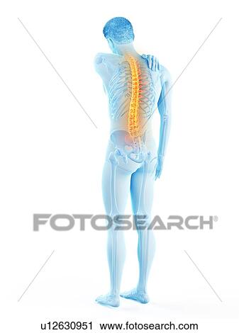 Stock Image - Back pain, conceptual illustration.. Fotosearch