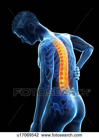 Stock Image - Back pain, conceptual illustration.. Fotosearch