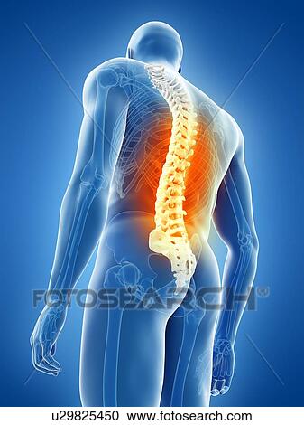 Stock Image - Back pain, conceptual illustration. Fotosearch