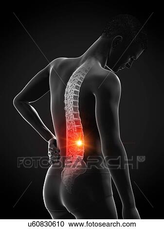 Stock Image - Back pain, conceptual illustration.. Fotosearch