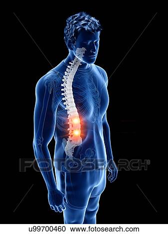 Stock Image - Back pain, conceptual illustration. Fotosearch