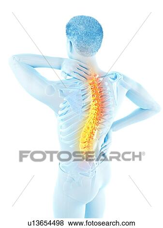 Stock Photo - Back pain, conceptual illustration.. Fotosearch