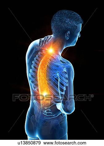 Stock Photo - Back pain, conceptual illustration.. Fotosearch