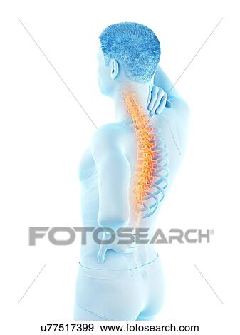 Stock Photo - Back pain, conceptual illustration.. Fotosearch