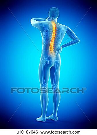 Stock Photograph - Back pain, conceptual illustration.. Fotosearch
