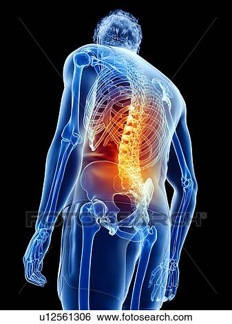 Stock Photograph - Back pain, conceptual illustration. Fotosearch
