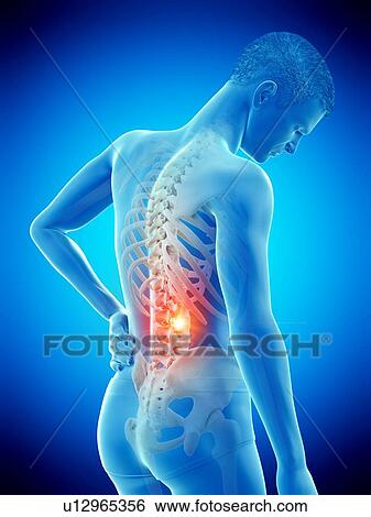 Stock Photograph - Back pain, conceptual illustration.. Fotosearch