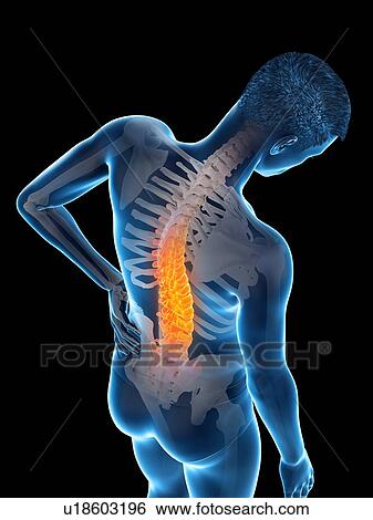 Stock Photograph - Back pain, conceptual illustration.. Fotosearch