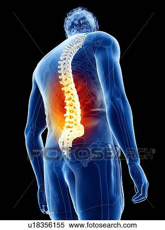 Stock Photography - Back pain, conceptual illustration. Fotosearch