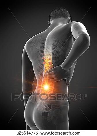 Stock Photography - Back pain, conceptual illustration.. Fotosearch