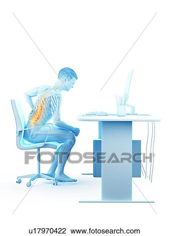 Stock Image - Back pain due to sitting, conceptual illustration.. Fotosearch