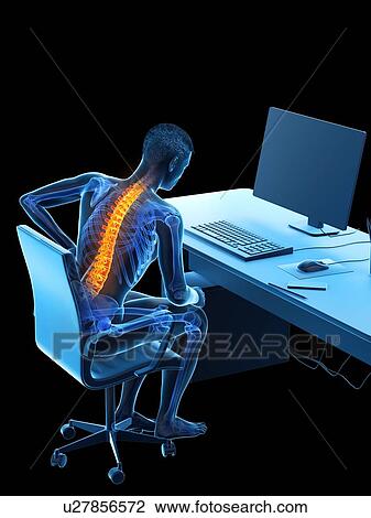 Stock Image - Back pain due to sitting, conceptual illustration.. Fotosearch