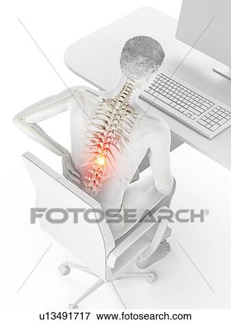 Stock Photo - Back pain due to sitting, conceptual illustration.. Fotosearch