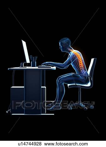 Stock Photo - Back pain due to sitting, conceptual illustration.. Fotosearch