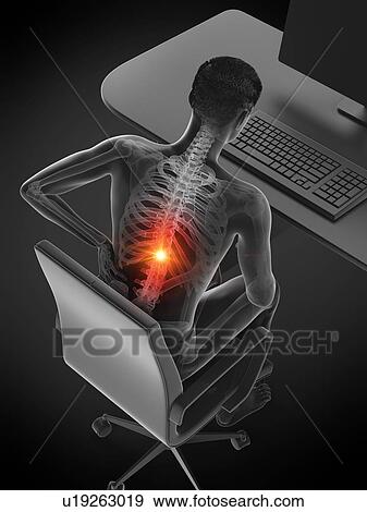 Stock Photo - Back pain due to sitting, conceptual illustration.. Fotosearch