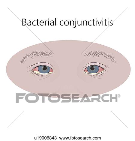 Stock Image - Bacterial conjunctivitis, illustration.. Fotosearch