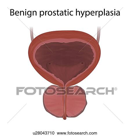 Benign prostatic hyperplasia, illustration. This is a non-cancerous enlargement of the prostate gland. View Large Photo Image Stock Image - Benign prostatic hyperplasia, illustration. This is a non-cancerous enlargement of the prostate gland.. Fotosearch