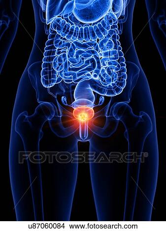 Bladder cancer, conceptual illustration View Large Photo Image Picture - Bladder cancer, conceptual illustration. Fotosearch