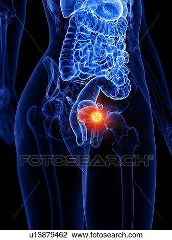Bladder cancer, conceptual illustration View Large Photo Image Stock Image - Bladder cancer, conceptual illustration. Fotosearch