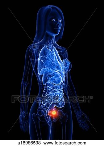 Bladder cancer, conceptual illustration View Large Photo Image Stock Photo - Bladder cancer, conceptual illustration. Fotosearch