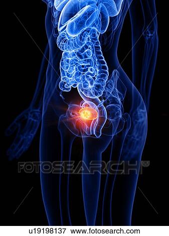 Stock Photo - Bladder cancer, conceptual illustration. Fotosearch