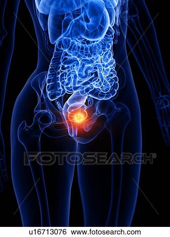 Stock Photograph - Bladder cancer, conceptual illustration. Fotosearch