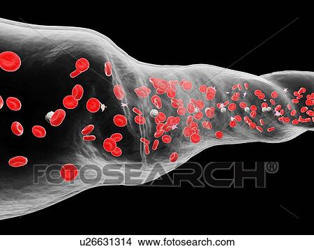 Picture - Blood vessel, computer illustration.. Fotosearch
