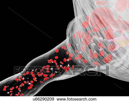Stock Photo - Blood vessel, computer illustration.. Fotosearch
